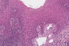 Acute mucositis of the tongue