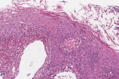 Acute mucositis of the tongue