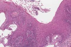 Acute mucositis of the tongue