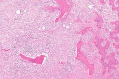 Acute osteomyelitis