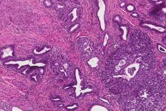 Adenocarcinoma in situ and high grade squamous intraepithelial lesion of the cervix