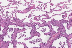 Adenocarcinoma in situ of the lung