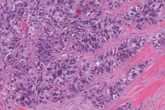 Adenocarcinoma NOS ex pleomorphic adenoma