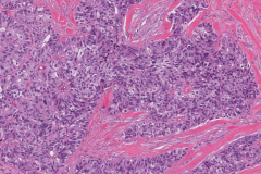 Adenocarcinoma NOS ex pleomorphic adenoma