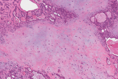 Adenocarcinoma NOS ex pleomorphic adenoma