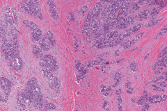 Adenocarcinoma NOS ex pleomorphic adenoma