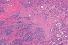 Adenocarcinoma NOS ex pleomorphic adenoma