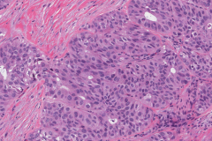 Adenocarcinoma NOS of the parotid gland