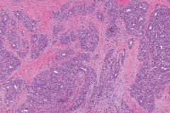 Adenocarcinoma NOS of the parotid gland