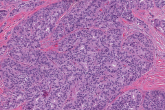 Adenocarcinoma NOS of the parotid gland