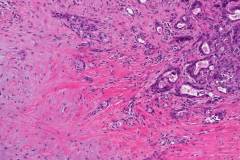 Adenocarcinoma NOS ex pleomorphic adenoma