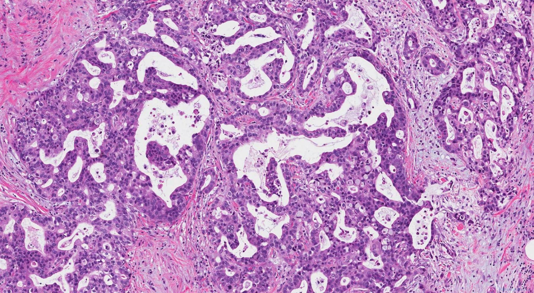 Ampullary adenocarcinoma | Atlas of Pathology