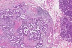 Adenocarcinoma of the ampulla