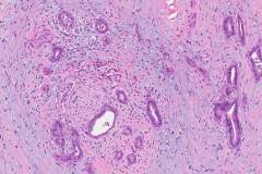 Ampullary adenocarcinoma