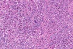 Ampullary adenocarcinoma