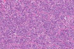 Ampullary adenocarcinoma