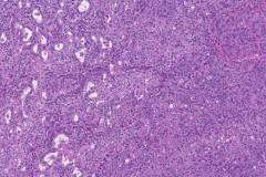 Ampullary adenocarcinoma