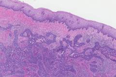 Poorly differentiated adenocarcinoma of the cervix