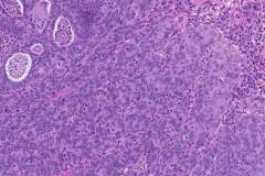 Poorly differentiated adenocarcinoma of the cervix