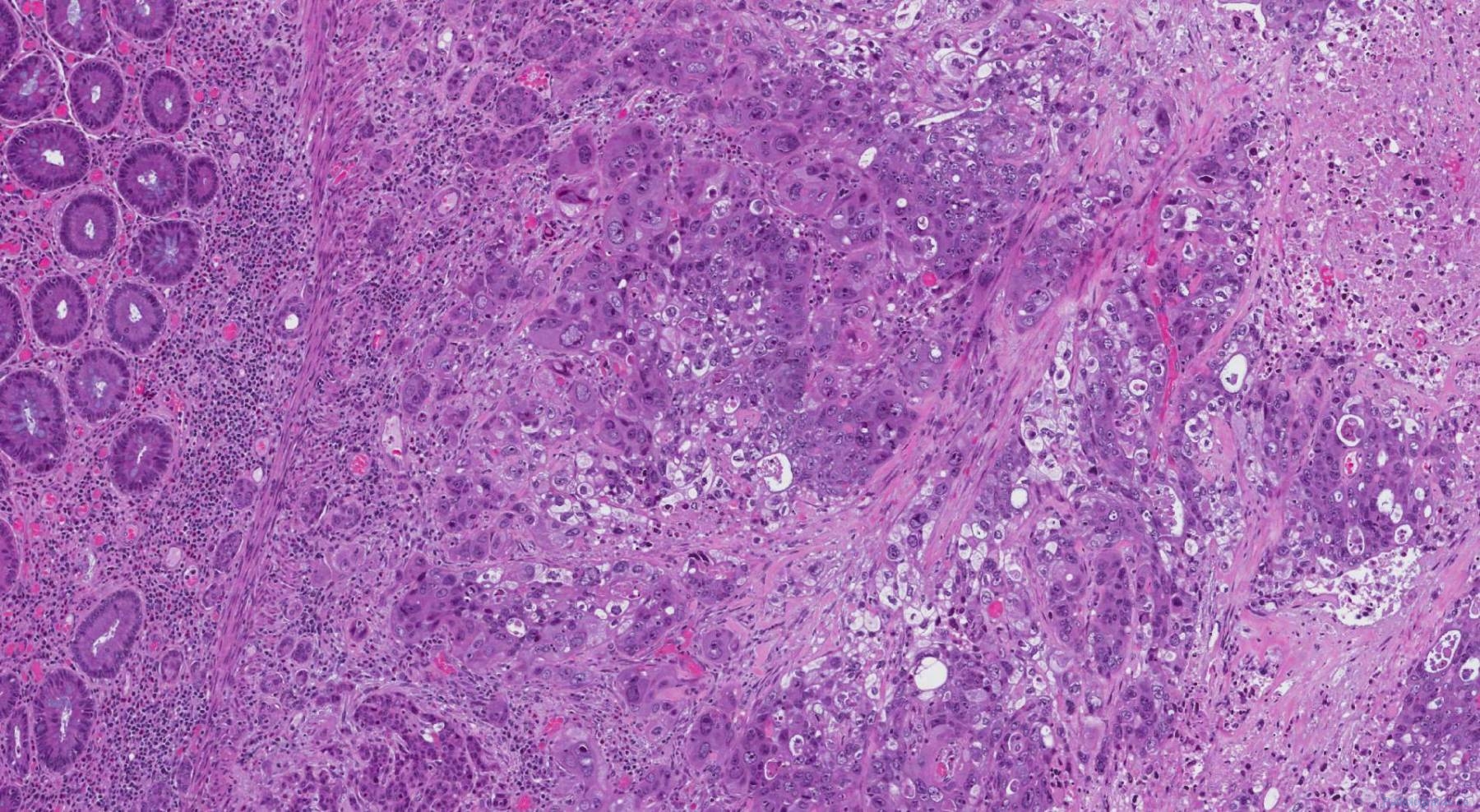 Adenocarcinoma of the colon | Atlas of Pathology