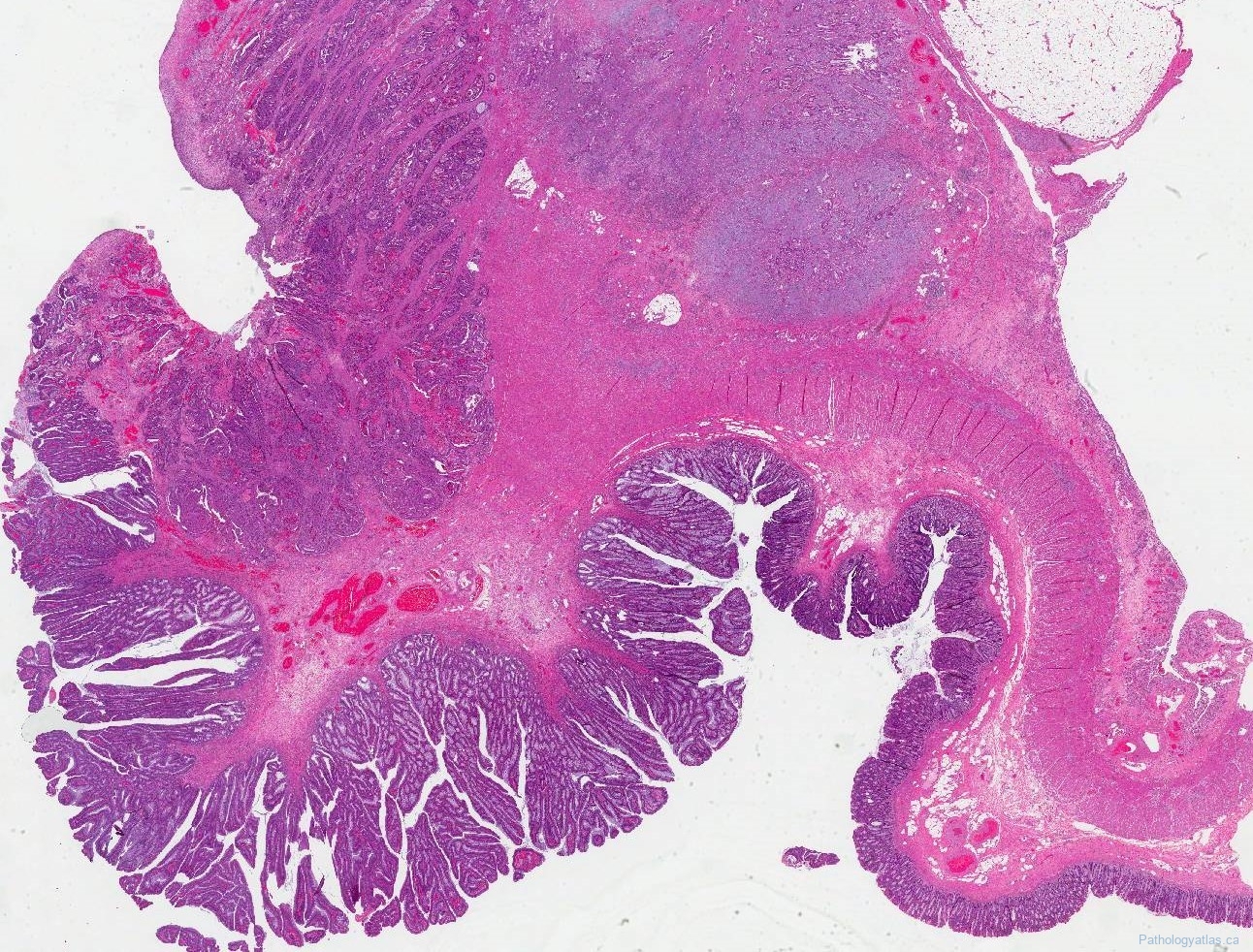 Adenocarcinoma Of The Colon Atlas Of Pathology 5443