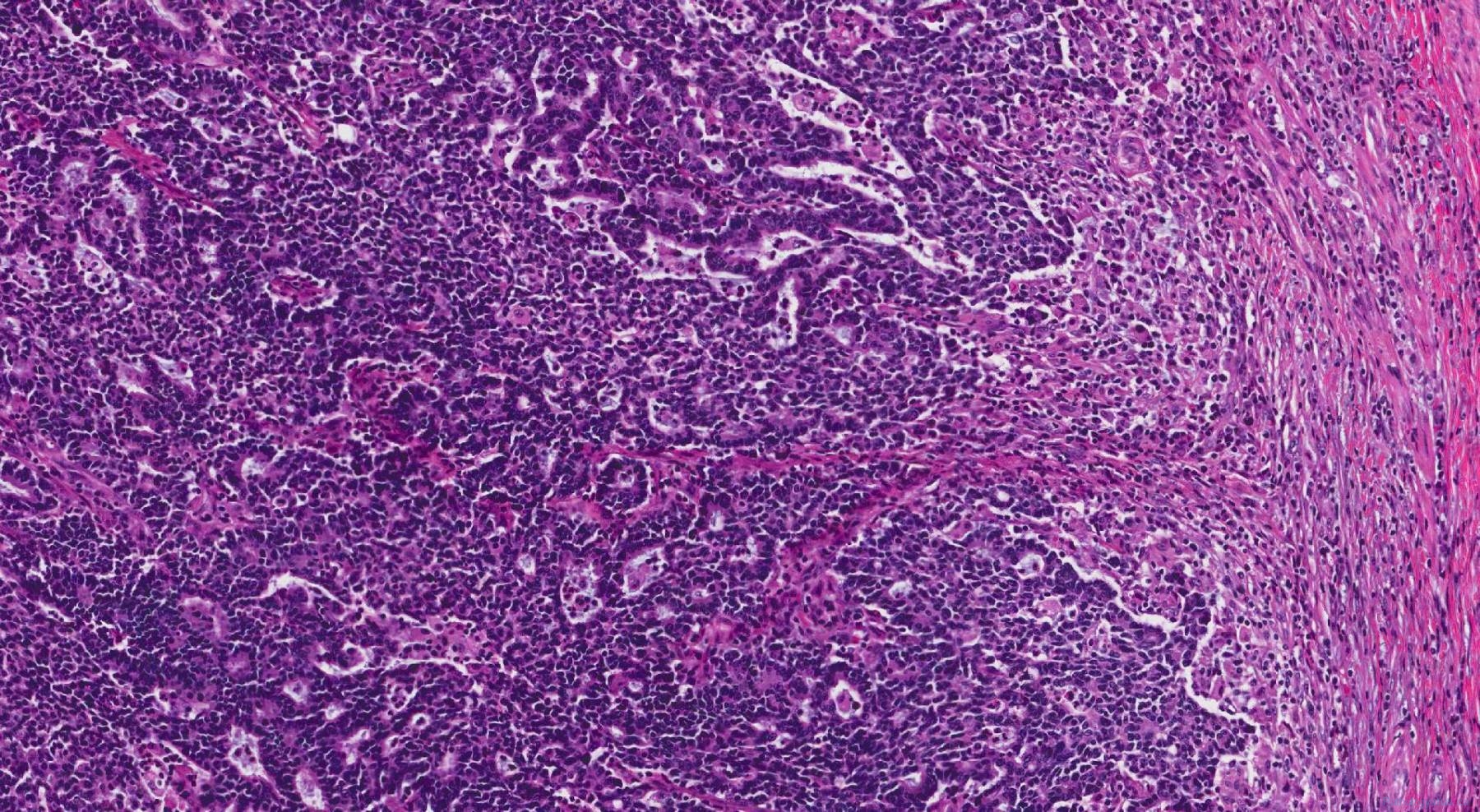 Adenocarcinoma of the colon | Atlas of Pathology