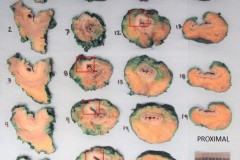 Resection of the rectum and sigmoid colon for adenocarcinoma