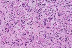 Adenocarcinoma of the gastroesophageal junction