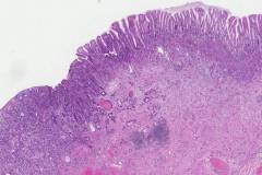 Adenocarcinoma of the gastroesophageal junction