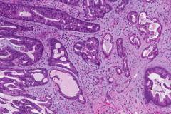 Adenocarcinoma of the esophagus