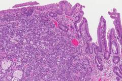 Adenocarcinoma of the esophagus arising from a background of Barrett's esophagus