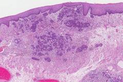 Adenocarcinoma of the esophagus