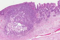 Adenocarcinoma of the esophagus arising from a background of Barrett's esophagus