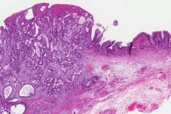 Adenocarcinoma of the esophagus arising from a background of Barrett's esophagus