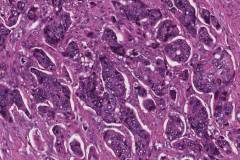 Adenocarcinoma of the gallbladder: Biliary type