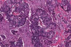 Adenocarcinoma of the gallbladder: Biliary type