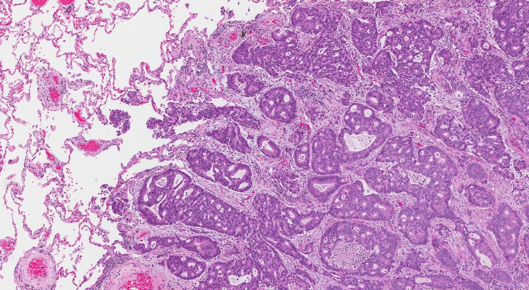 Adenocarcinoma Of The Lung 