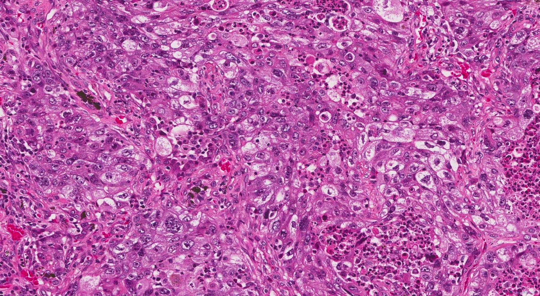 Adenocarcinoma of the lung | Atlas of Pathology