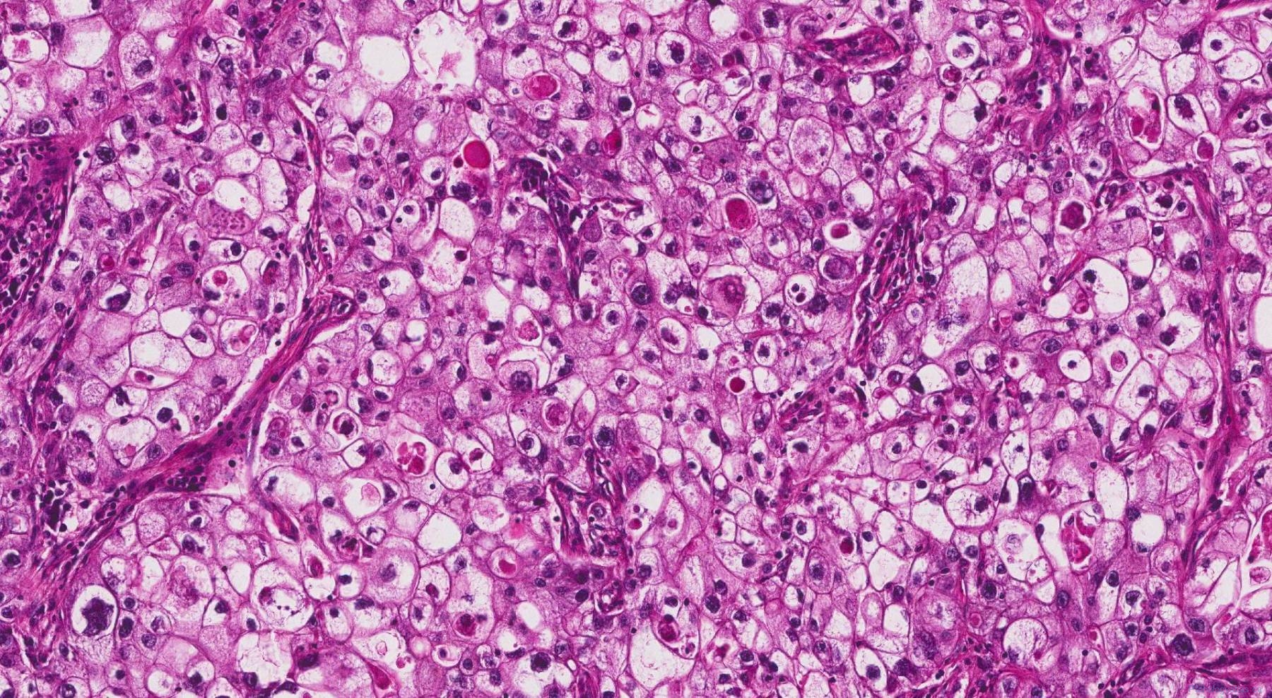 Adenocarcinoma Of The Lung | Atlas Of Pathology