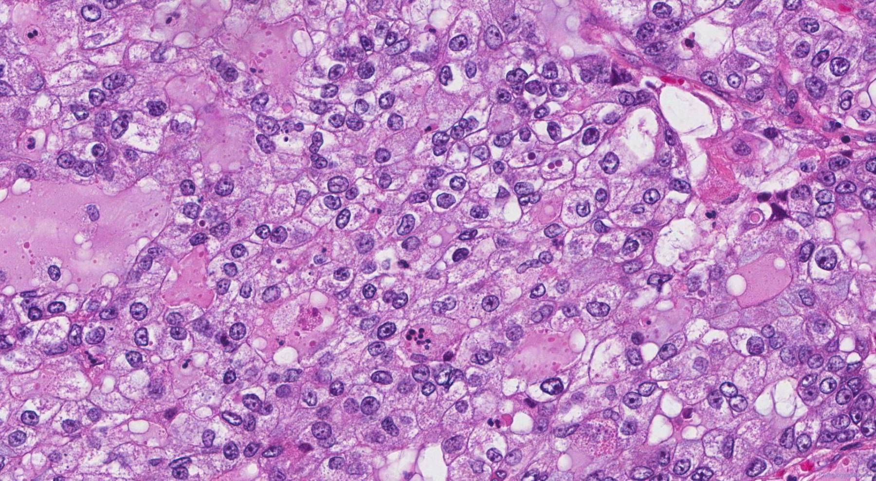 Adenocarcinoma of the lung | Atlas of Pathology