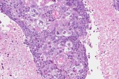 Metastatic adenocarcinoma of the lung to the brain