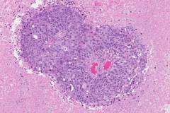 Metastatic adenocarcinoma of the lung to the brain