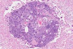 Metastatic adenocarcinoma of the lung to the brain