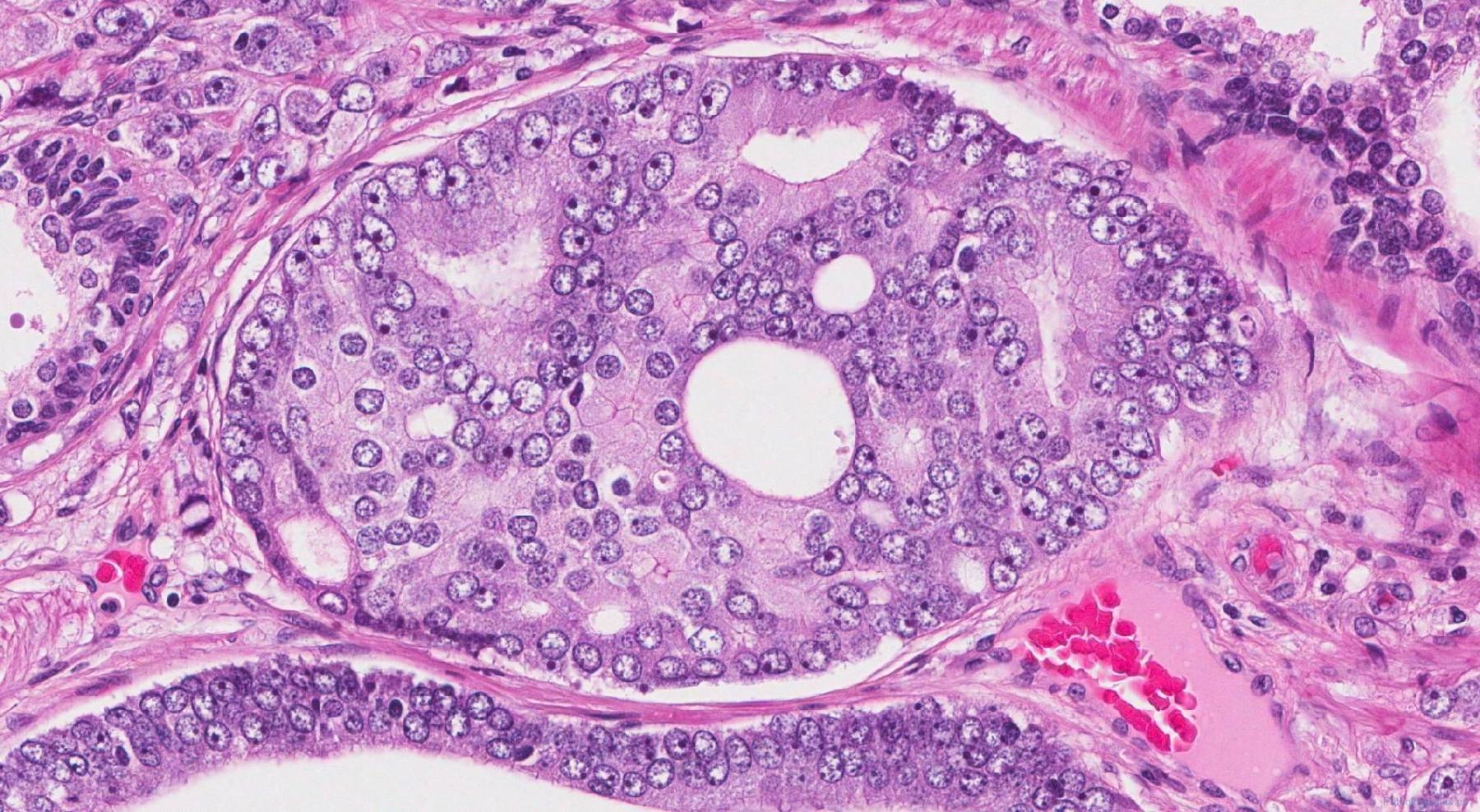 Adenocarcinoma Of The Prostate Gland Ottawa Atlas Of Pathology 2789