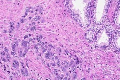 Adenocarcinoma of the prostate gland