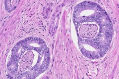 Adenocarcinoma of the prostate gland