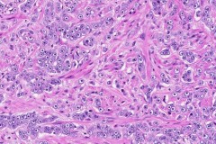 Adenocarcinoma of the prostate gland