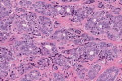 Adenocarcinoma of the prostate gland