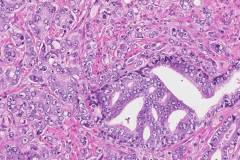 Adenocarcinoma of the prostate gland