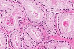 Adenocarcinoma of the prostate gland, foamy variant